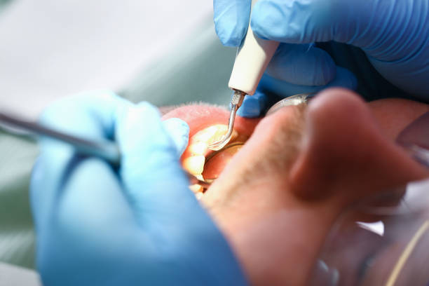 Best Emergency Dental Care for Abscessed Tooth in Briarcliff Manor, NY